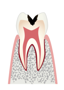 【C2】歯の内部まで進行したむし歯